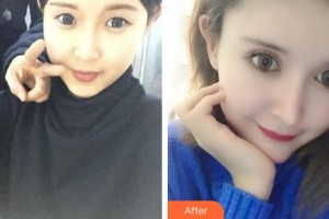 榮成眼科醫(yī)院楊華強(qiáng)整形價(jià)格表附眼部綜合案例展示