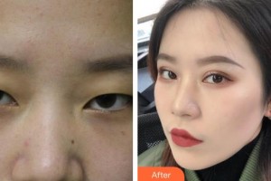 榮成眼科醫(yī)院尹彩芳整形價(jià)格表附眼部綜合案例展示