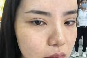 萬家燕王珍祥做下頜角怎么樣截的多嗎？附案例分享+較新價格表