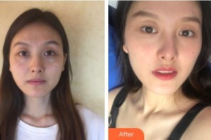 惠陽(yáng)人民醫(yī)院崇雅路門(mén)診部醫(yī)療美容科何麗玲整形價(jià)格表附鼻部綜合案例展示