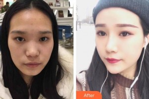 惠陽(yáng)人民醫(yī)院崇雅路門(mén)診部醫(yī)療美容科劉輝良整形價(jià)格表附耳軟骨復(fù)合隆鼻案例展示