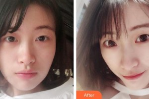 惠陽(yáng)長(zhǎng)安醫(yī)院整形美容中心李文珍整形價(jià)格表附鼻部綜合案例展示