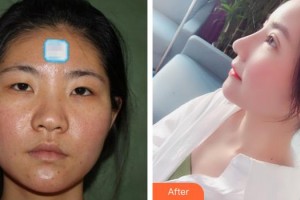 惠陽(yáng)長(zhǎng)安醫(yī)院整形美容中心陳國(guó)軍整形價(jià)格表附鼻部綜合案例展示