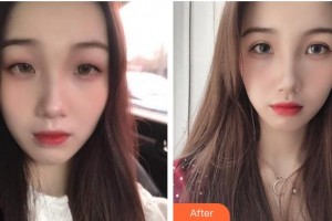 龍口光明眼科醫(yī)院范慧君整形價(jià)格表附切開(kāi)雙眼皮案例展示