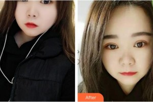 龍口光明眼科醫(yī)院張少斌整形價(jià)格表附切開(kāi)雙眼皮案例展示