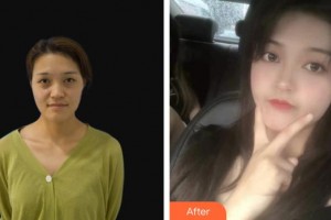 龍口光明眼科醫(yī)院滿輝整形價(jià)格表附眼部綜合案例展示