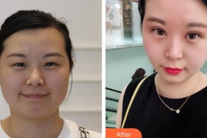 龍口光明眼科醫(yī)院王繼兵整形價(jià)格表附眼部綜合案例展示