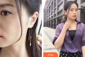 龍口光明眼科醫(yī)院李超英整形價(jià)格表附激光去黑眼圈案例展示