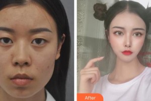 龍口光明眼科醫(yī)院李健整形價(jià)格表附眼部綜合案例展示