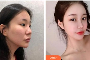 龍口光明眼科醫(yī)院胡聰整形價(jià)格表附眼部綜合案例展示