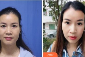 鹿邑眼科醫(yī)院劉志才整形價(jià)格表附激光去黑眼圈案例展示