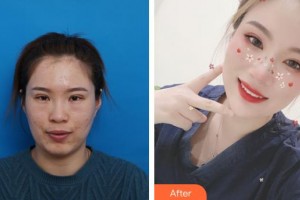 鹿邑眼科醫(yī)院李金榮整形價(jià)格表附激光去眼袋案例展示