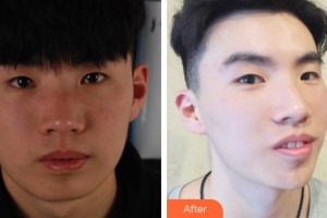 宜興市和橋醫(yī)院燒傷整形外科周松晏整形價(jià)格表附彩光嫩膚案例展示