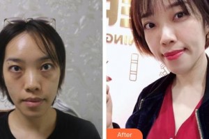 濟(jì)源現(xiàn)代女子醫(yī)院整形美容中心許方馨整形價(jià)格表附激光去眼袋案例展示
