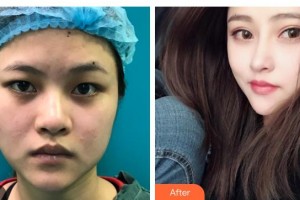 濟(jì)源尖峰眼科醫(yī)院張建平整形價(jià)格表附切開雙眼皮案例展示