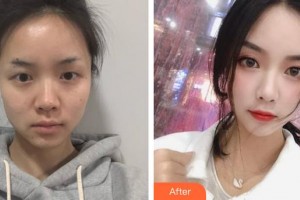 濟(jì)源尖峰眼科醫(yī)院張磊整形價(jià)格表附開內(nèi)眼角案例展示