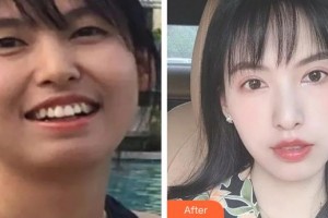 濟(jì)源霍氏口腔醫(yī)院霍文靜整形價(jià)格表附美白貼片案例展示