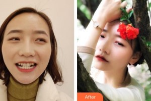 濟(jì)源霍氏口腔醫(yī)院段宗華整形價(jià)格表附牙齒隱形矯正案例展示