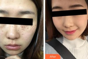 大理漾濞縣人民醫(yī)院整形美容科關(guān)志江整形價格表附激光祛斑案例展示