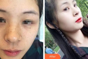 大理金格醫(yī)療美容醫(yī)院姚明華整形價(jià)格表附激光祛斑案例展示