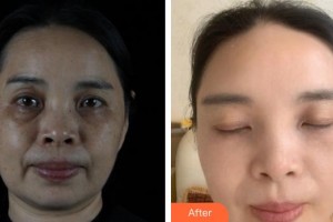 大理韓美醫(yī)療美容醫(yī)院劉隆才整形價格表附激光祛斑案例展示