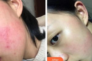 大理市第一人民醫(yī)院美容皮膚科洪春梅整形價格表附光子嫩膚案例展示