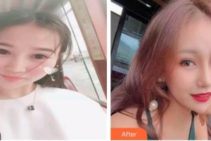 大理華山眼科醫(yī)院洪波整形價格表附眼部綜合案例展示