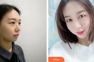 大理華山眼科醫(yī)院李敏整形價(jià)格表附切開(kāi)雙眼皮案例展示