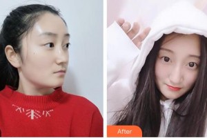 大理華山眼科醫(yī)院田玉枝整形價格表附切開雙眼皮案例展示