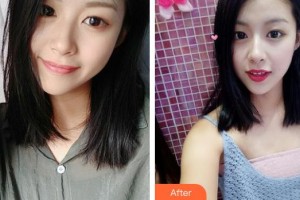 唐河?xùn)|方眼科醫(yī)院李斌整形價格表附切開雙眼皮案例展示