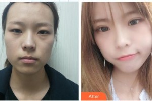 唐河?xùn)|方眼科醫(yī)院楊華岳整形價格表附切開雙眼皮案例展示