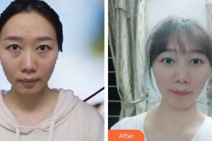 唐河?xùn)|方眼科醫(yī)院張清勇整形價格表附激光去眼袋案例展示