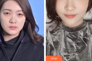 唐河?xùn)|方眼科醫(yī)院張偉整形價格表附切開雙眼皮案例展示