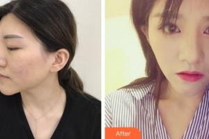 郯城新益民眼科醫(yī)院魏寧整形價格表附定點雙眼皮案例展示