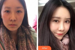 郯城新益民眼科醫(yī)院楊玉英整形價格表附外切祛眼袋案例展示