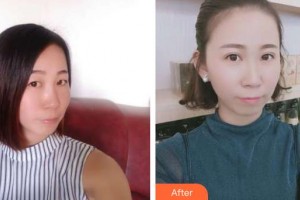 郯城新益民眼科醫(yī)院王君怡整形價格表附眼部綜合案例展示