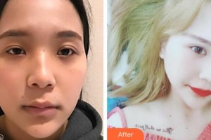 郯城新益民眼科醫(yī)院李光達(dá)整形價格表附切開雙眼皮案例展示