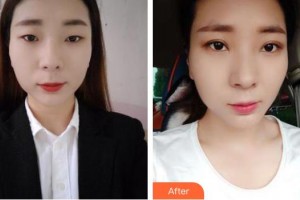 邯鄲京美整形醫(yī)院張丙海整形價格表附眼部綜合案例展示