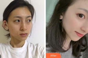 邯鄲京美整形醫(yī)院杜艷整形價格表附激光祛斑案例展示