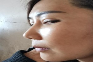 韓國一見Izien整形外科醫(yī)院金一秀輪廓修復整形果分享