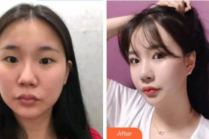 邯鄲華美醫(yī)療美容醫(yī)院王凱整形價格表附眼部綜合案例展示