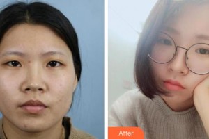 邯鄲中信皮膚科門診部韓振濤整形價格表附切開雙眼皮案例展示