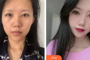 邯鄲金皇后醫(yī)療美容診所張愛花整形價格表附眼部綜合案例展示