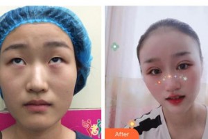 邯鄲市眼科醫(yī)院張軍明整形價(jià)格表附眼部整形雙眼皮切開雙眼皮案例展示