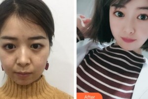 邯鄲市眼科醫(yī)院高鐵瑛整形價格表附定點雙眼皮案例展示