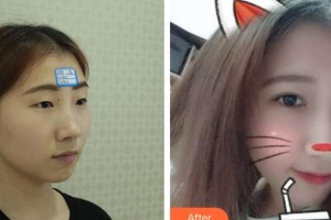 邯鄲市眼科醫(yī)院雷秀麗整形價格表附眼部修復(fù)案例展示