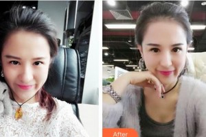 邯鄲市眼科醫(yī)院韋敏整形價格表附埋線雙眼皮案例展示