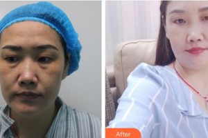 邯鄲市眼科醫(yī)院李玉剛整形價(jià)格表附切開雙眼皮案例展示