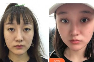 邯鄲愛爾眼科醫(yī)院陳龍整形價(jià)格表附眼部修復(fù)案例展示