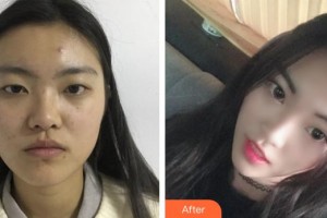 邯鄲京美整形醫(yī)院張芳輝整形價格表附切開雙眼皮案例展示